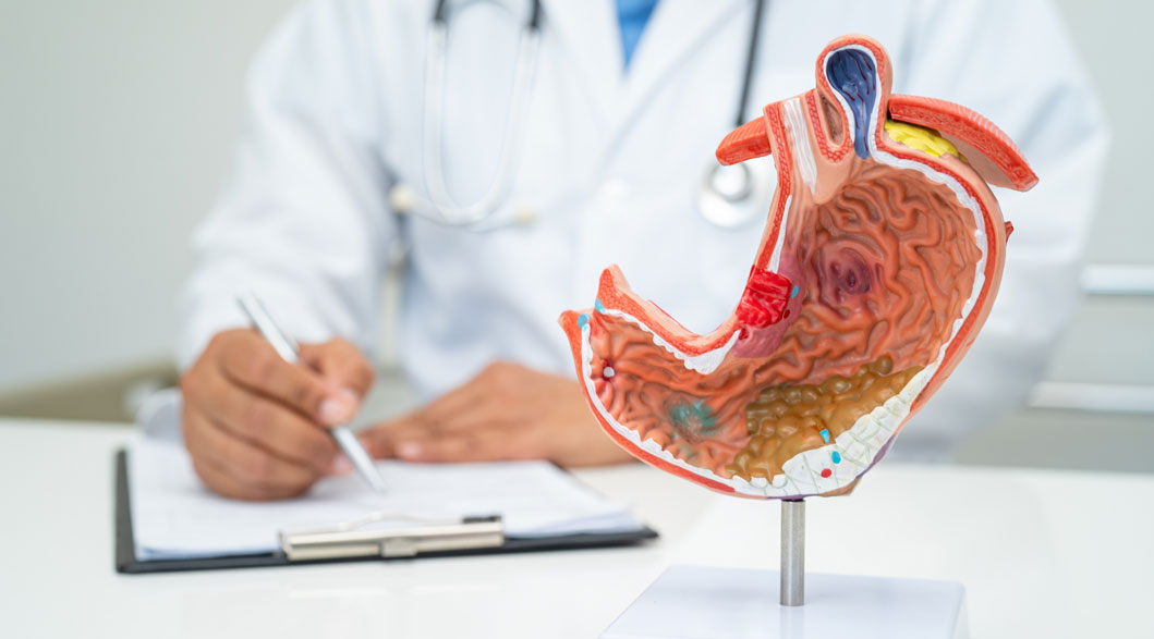 Who Should Get Early Gastric Cancer Screening?