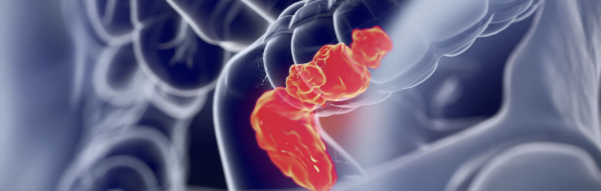 Colorectal Cancer Singapore
